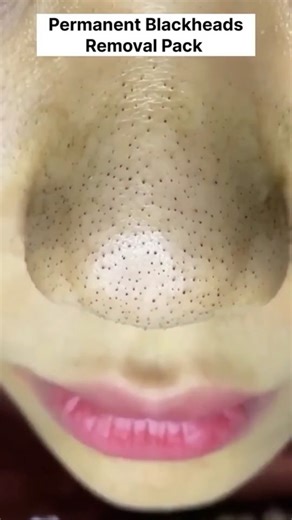 Health Beauty Treat on Instagram: "Remove Blackheads Permanently At Home | Blackhead Removal Easy Tips 😱 Clear Glass Skin #blackheads #whiteheads #clearskintips #skincare #blackheadsremoval #blackheadsremover #reels #ɪɴsᴛᴀʟɪᴋᴇ #ınstagood #instaexplore"