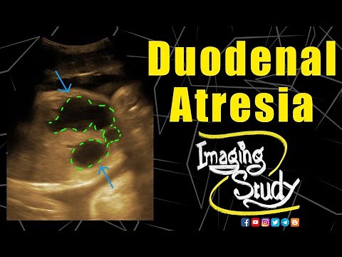Fetal Duodenal Atresia || Ultrasound || Case 138