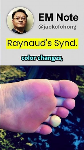 Raynaud's Syndrome or Raynaud's Phenomenon