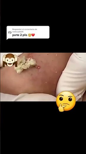 Blackhead Extraction 2021