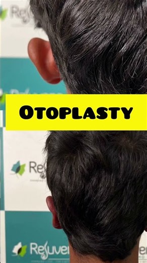 Bat Ear Correction Before & After | Otoplasty Surgery Results | Dr. Deepesh Goyal Jaipur