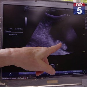 A southern white rhinoceros at the San Diego Zoo Safari Park zoo has been successfully impregnated through artificial insemination. Officials say it’s a first for the zoo, and they hope to use the same technique to bring back the northern white rhino from the brink of extinction. 📹: San Diego Zoo Safari Park | FOX 5 San Diego