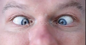 Young man with blue eyes squints. Correction of strabismus in adults concept