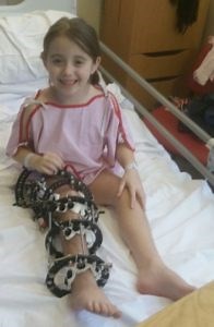 Fibular Hemimelia - STEPS Charity
