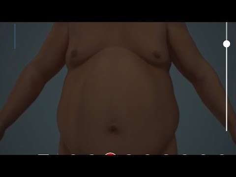 Managing Bariatric Abdomen in Surgery | Tips & Techniques .