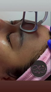 16K views · 30 reactions | Acne Scar Laser Treatment @ Oli’s Spa and Skin care. #co2fracrionallaser #co2laser #acnescars | Oli's Spa and Skin Care | Facebook