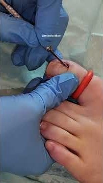 Satisfying ingrown toenail removal! 👣✨