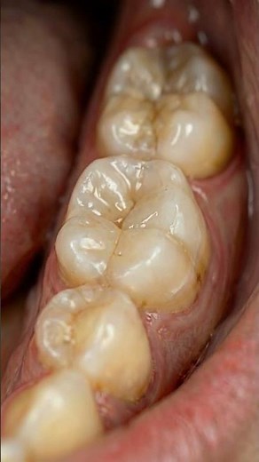 The Ultimate Clean: Scraping Off Hardened Plaque |#toothcraft #dentalprocedure #satisfying