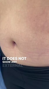 Belly button after tummy tuck