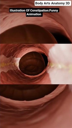 Illustration of constipation | Gut Health | Body Arts Anatomy 3D