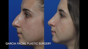 Most Popular Surgery at GFPS