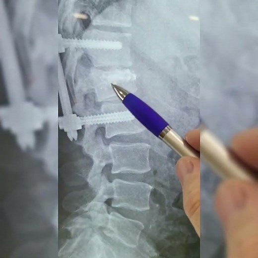 Cirugía de fractura de vertebra lumbar