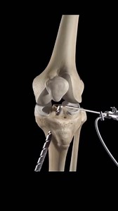 Ever wondered what happens in an ACL Reconstruction? Here and example of a hamstring graft reconstruction. Injured your ACL? Send us a DM today! #theclubphysio #physio #physiotherapy #acl #aclinjury #aclgraft #hamstring #hamstringgraft #injury #reconstruction #surgery #kneepain #kneeinjury #kneesurgery #kneerehab #aclreco #aclinjury #nrl #afl #nba #nhl #nfl #rugby #soccer #football #netball | The Club Physio