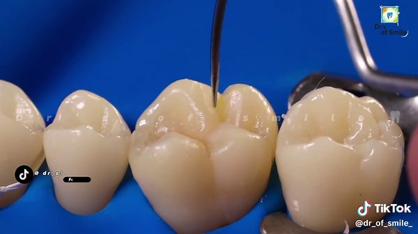 Class I Cavity Direct Layering Composite Restoration Guide