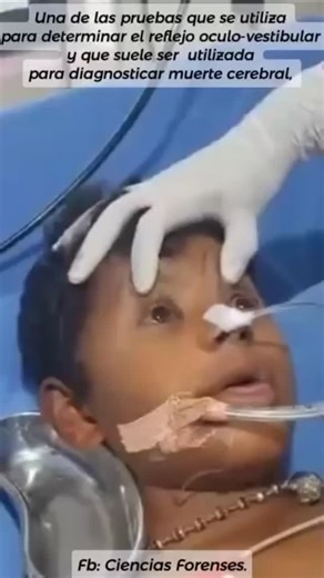 Ciencias Forenses on Instagram: "#Medicina #Neurología #Educación. A la respuesta ocular o movimientos oculares involuntarios, se le conoce como nistagmo. Es un indicador importante que subraya la existencia de funcionalidad en el sistema vestibular y el tronco encefálico. Su utilidad es aplicable en aquellos pacientes en estado de coma, que tienen lesiones/daños en el tronco encefálico/neurológicos, o en su defecto cuando existe sospecha de mu3rte cerebral. Únete a nuestro grupo privado: Concie