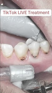Watch Me Restore 3 Class 5 Cavities LIVE 😱