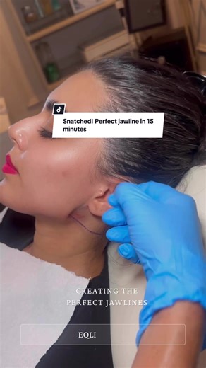 Achieve a Perfect Jawline with PDO Threads