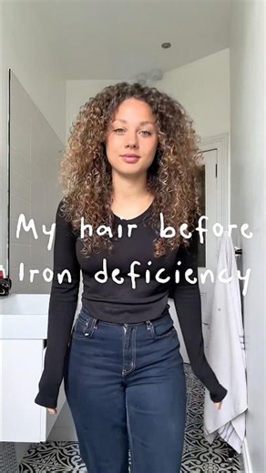 Iron deficiency hair loss / tellogeneffluvium stress #hairloss #tellogeneffluvium #irondeficiency