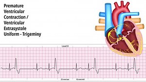 Premature Ventricular Contraction Pvc Uniform Trigeminy Stock Footage Video (100% Royalty-free) 3663316235 | Shutterstock