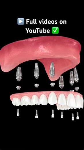 🎥 3D Dental Animations🦷 Implants • Veneers • Ortho #dentist #dentalcare #implaimplants ants
