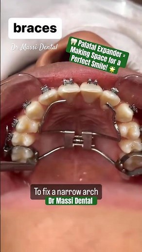 🦷 Palatal Expander = Making Space for a Perfect Smile! 🌟