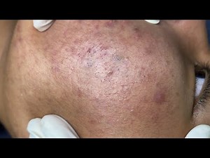 Đập tan tự ti nhờ trị mụn chuyên sâu