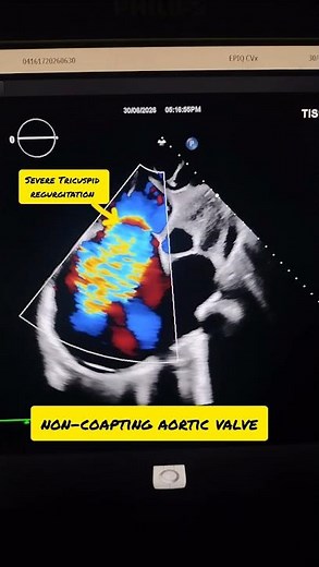 Severe Tricuspid Regurgitation (TR) due to a Non-Coapting Tricuspid Valve | Echo Case