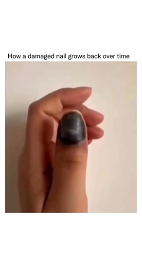 Detailed Explanation on Instagram: "The time it takes for a damaged nail to heal depends on the severity of the injury and whether it affects the fingernail or toenail. Fingernails generally grow faster, taking about three to six months to fully regrow, while toenails may take six to twelve months. The healing process begins with the body repairing any injury to the nail bed, which is the skin beneath the nail plate. If the nail is bruised or partially detached, blood may collect underneath, cau