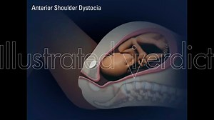 Shoulder Dystocia, McRoberts Maneuver. and Delivery of the Posterior Arm