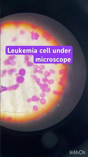 Leukemia cell under microscope ! #blast