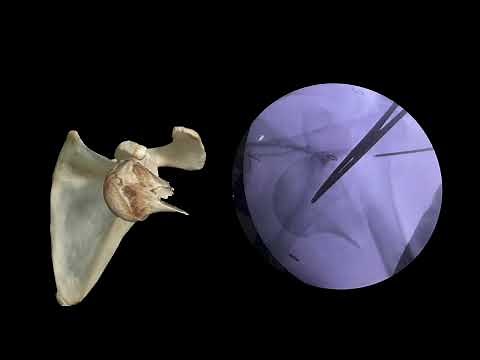 Reduction tips Proximal Humerus Fracture Dislocations
