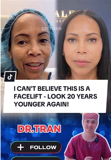 Experience a Facelift: Look 20 Years Younger!