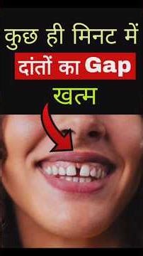 Front Teeth Gap Treatment #Kuch Hi Minutes Me Danto Ka Gap Khatam