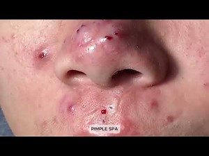 BRUTAL Forehead Pimple Popping EXPLOSION – Deep Pus Drainage ASMR