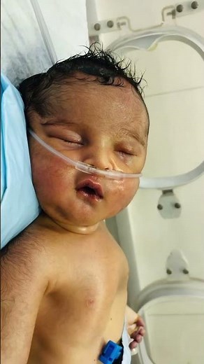 Critical Birth Asphyxia Case | Oxygen Support, Cyanosis & Severe Distress | NICU Emergency Care 👶🫁
