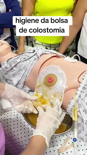 Técnica de Enfermagem: Como Colocar Bolsa de Colostomia de Forma Correta