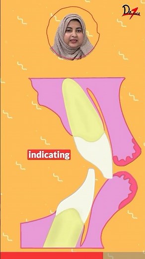 Dentist Tips: Correcting Maxillary Incisor Length Easily! #drteeth #fullmouthrehabilitation