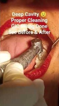 LowerLeftFirst&SecondMolar CariesTreatment Cavity Cleaning&GICFillingBeforevsAfter #thedentalguru