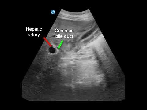 Acalculous Cholecystitis Findings