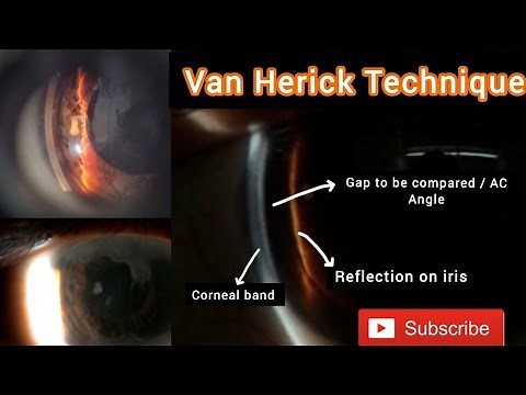Van Herick Technique || Method to Assess Anterior Chamber Depth