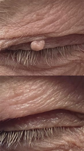 Come on superman, say your stupid line… “it’ll just feel a little bit cold” me, every time, knowing full well CryoPen is about to make you question my definition of a little ❄️ Cold? yes. Stingy? yes. Quick? also yes. Effective? 100%. If you want unwanted skin lesions treated professionally in 2026, tap the link in my bio and book cryotherapy consultation’ we can’t wait to help! | The Glow. Co