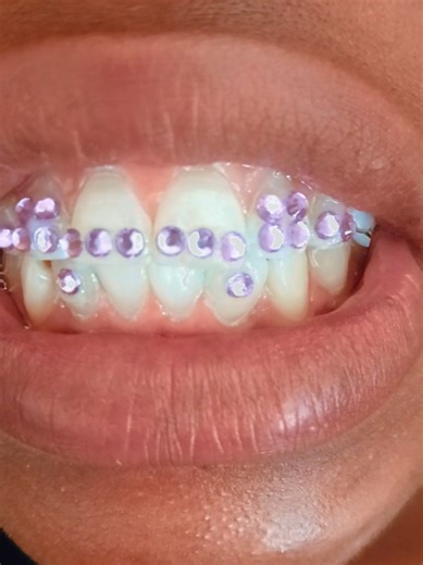 Fashion Braces Installation at Janefurse and Burgersfort