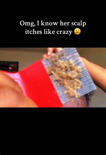 Seborrheic dermatitis or psoriasis? asmr #asmrvideo #asmrsounds #asmrhair #removingdandruff #asmrhairplay #satisfying #oddlysatisfying #relaxing #scalpscratching #scalpscrub #scratching #scratchingsoundsasmr #itchyscalp #scalpmassage #asmrsleep #tingles #triggers #asmrtriggers #asmrtingles #tingle #nitpicking #dandruffscratching #dandruff #flakes #scalpcheck #scalpcheckasmr #scalpmassage #asmrhairplay #psoriasis #psoriasisawareness #seborrheicdermatitis #bigflakes #scalpcare