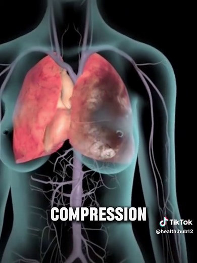 Deep Vein Thrombosis (DVT) #deepveinthrombosis #DVT #bloodclot #medicalanimation