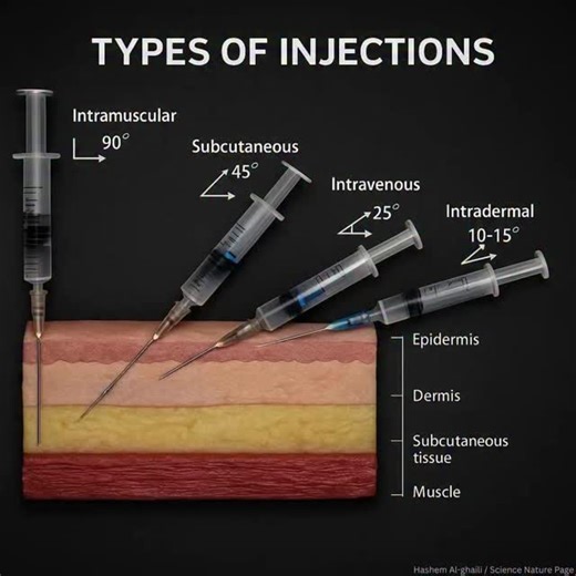 Radiology Imaging 🩻☢️ on Instagram: "Needle angles matter more than you think 💉 One wrong angle = wrong layer 👀 💉 Types of injections & correct angles: 🔹 Intramuscular (IM) – 90° → Delivers medication deep into muscle for faster absorption 🔹 Subcutaneous (SC) – 45° → Injected into fatty tissue for slow, steady absorption 🔹 Intravenous (IV) – ~25° → Direct access to bloodstream for immediate effect 🔹 Intradermal (ID) – 10–15° → Just under the epidermis (used for tests like Mantoux) 📌 Kno