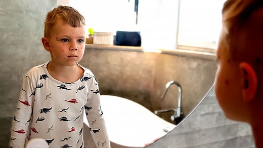 Why Chickenpox Only Happens Once In A Lifetime? Expert Answers