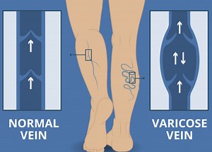 Sclerotherapy - Miami Skin Spa