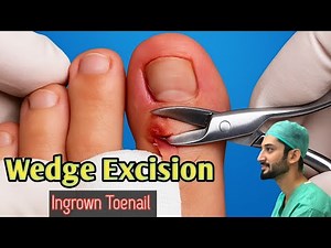 Wedge Excision for Ingrown Toenails | Step by Step Procedure | Dr Mujtaba Ameen