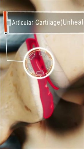 How does Spinal Arthritis Cause Pain?