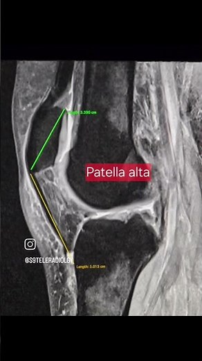Infrapatellar fat pad Impingement or friction syndrome #kneepain #radiology #mri #medicaleducation